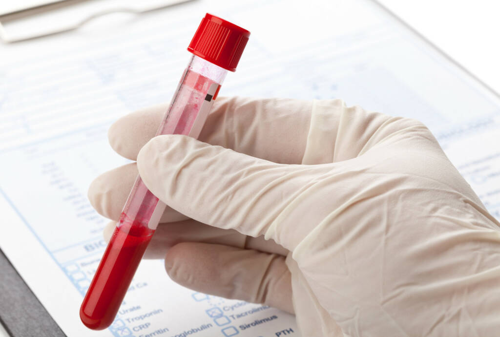 Blut, Blutprobe, Latex Handschuh http://www.shutterstock.com/de/pic-173050052/stock-photo-hand-with-latex-glove-holding-blood-sample-vial-in-front-of-blood-test-form.html, © www.shutterstock.com (25.03.2015) 