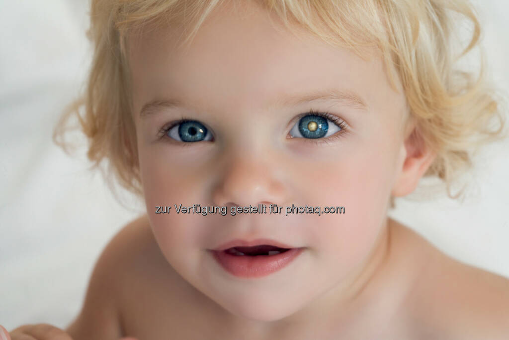 Weiße Pupille auf Blitzlichtfotos ist Warnzeichen von Augenkrebs bei Kindern - Österreichische Kinder-Krebs-Hilfe: „Weiß sehen.“ – Aufklärung für Eltern über Augenkrebs bei Kindern (Fotocredit: KinderAugenKrebsStiftung), © Aussender (15.02.2017) 