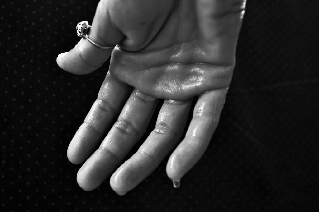 Schwitzen, Schweiß, Hand (Bild: Pixabay/BarbaraBonanno https://pixabay.com/de/hand-hyperhidrose-schwitzen-1502242/ )    (28.04.2017) 